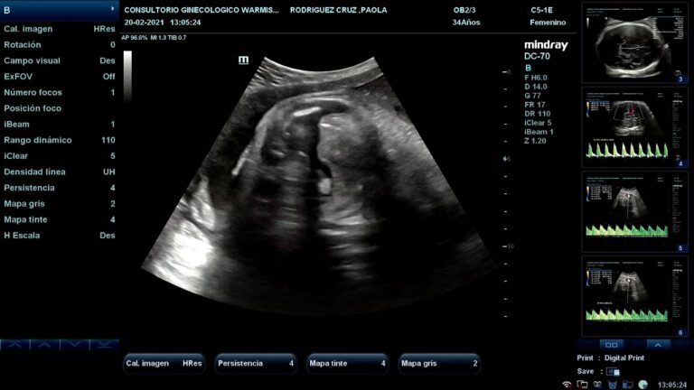 Doppler en el embarazo: Optimizando la detección de complicaciones