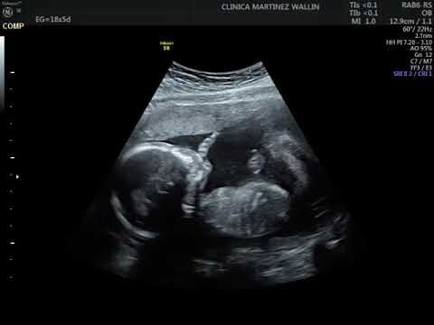 Ecografía a las 18 semanas: Una mirada detallada al desarrollo fetal